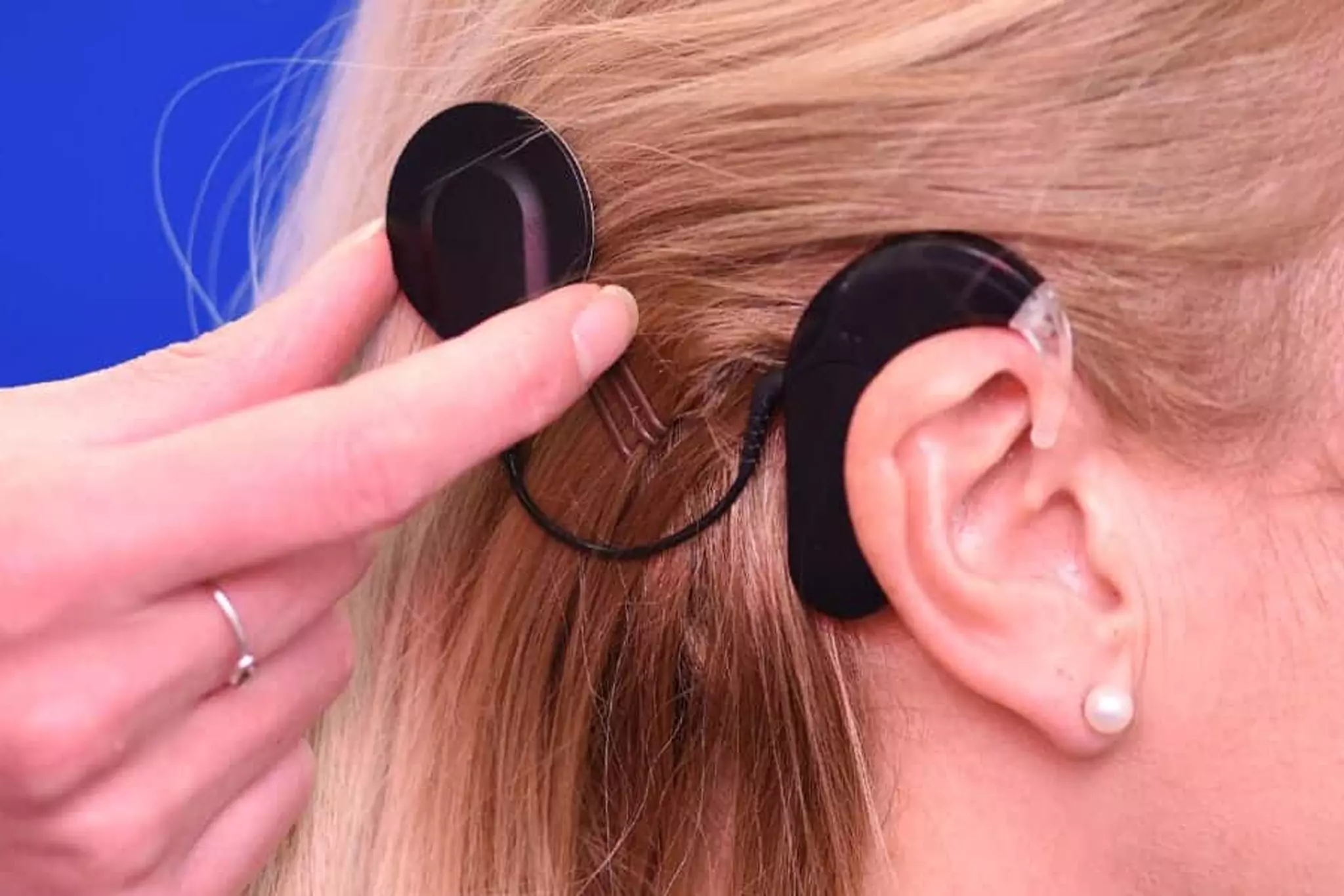 cochlear implant 2