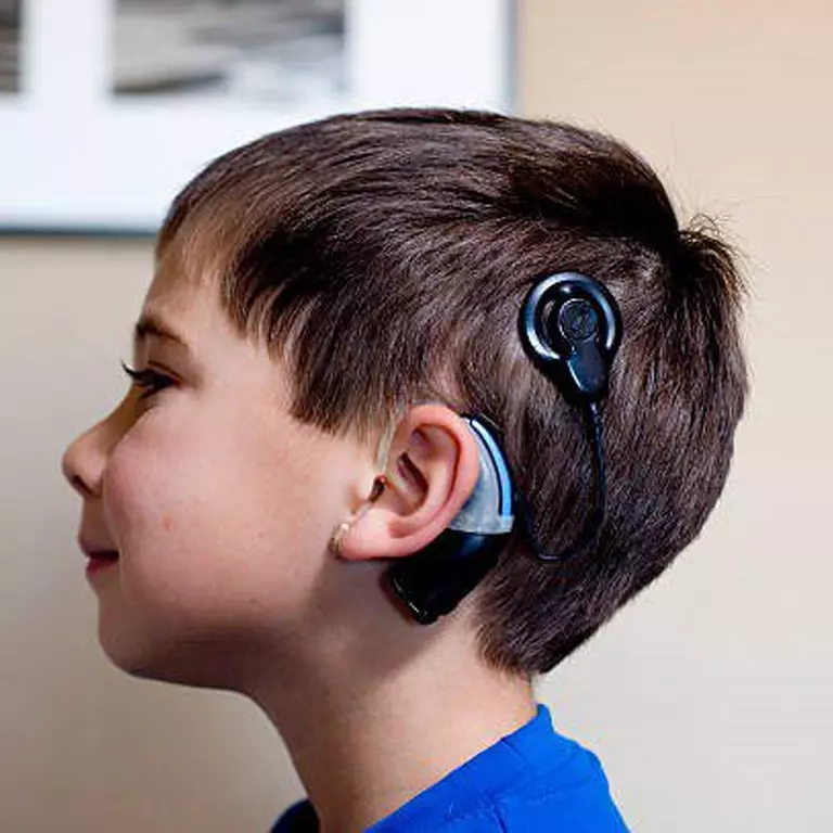 cochlear implant 3